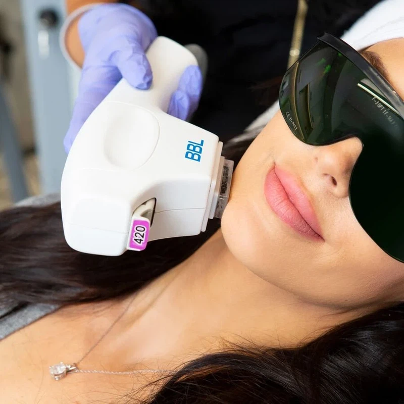 BBL Laser Treatment BBL Laser Treatment